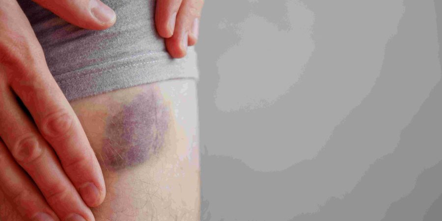 From Investigation To Resolution Understanding Your Rights After A Slip And Fall Injury On A Patio - Abogados de Accidentes Chula Vista